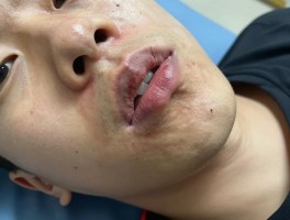 打篮球嘴唇受伤怎么办,如何快速消肿止痛,伤口需要缝针吗